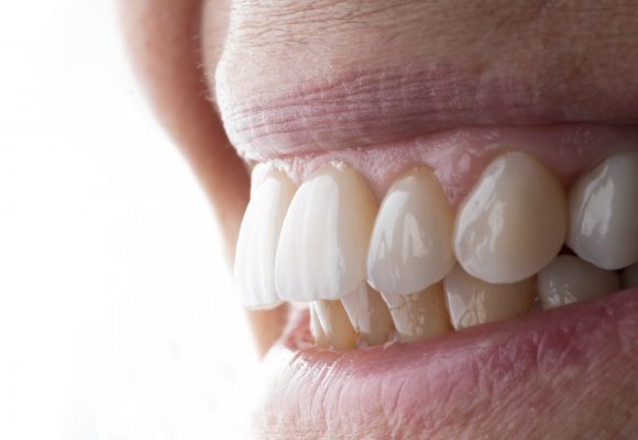 Facetas dentárias, as 6 coisas que precisa de saber!
