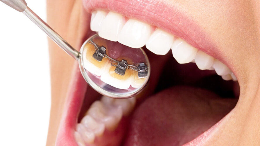 Ortodontia-Aparelho-lingual