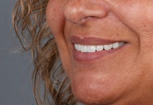 Implantes Dentários