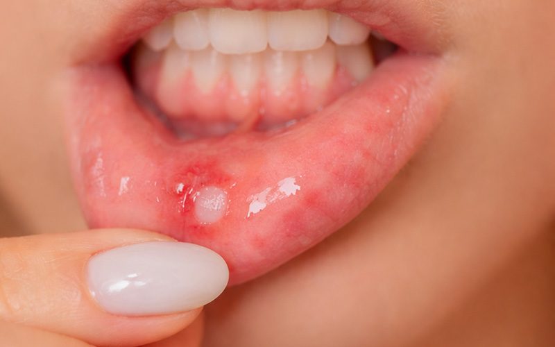 As aftas são pequenas lesões na mucosa oral que podem causar dor e desconforto ao comer ou falar. O que são aftas? São úlceras superficiais que surgem na boca, geralmente esbranquiçadas no centro e rodeadas por uma área avermelhada. São benignas e desaparecem espontaneamente na maioria dos casos. Porque aparecem as aftas? Podem estar associadas a: Stress Traumatismos Alterações hormonais Baixa imunidade Deficiências vitamínicas Alimentos ácidos ou picantes Aparelhos ortodônticos